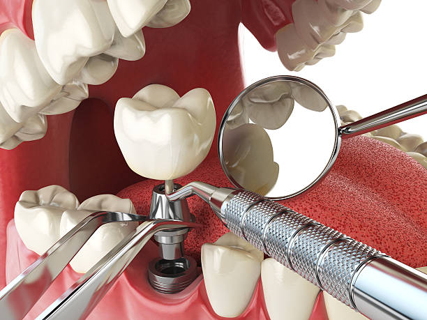 Best Emergency Tooth Extraction in Morro Bay, CA